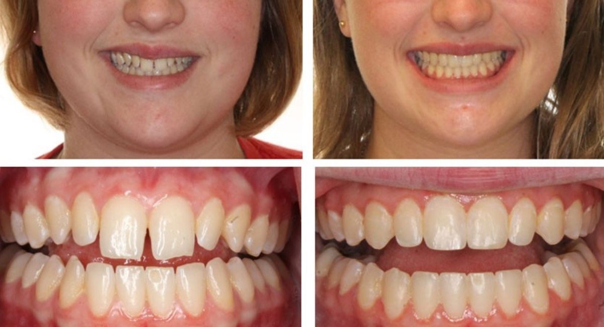 Jaw Before and After Braces: Complete Guide to Changes and Results 2 Jaw Before and After Braces