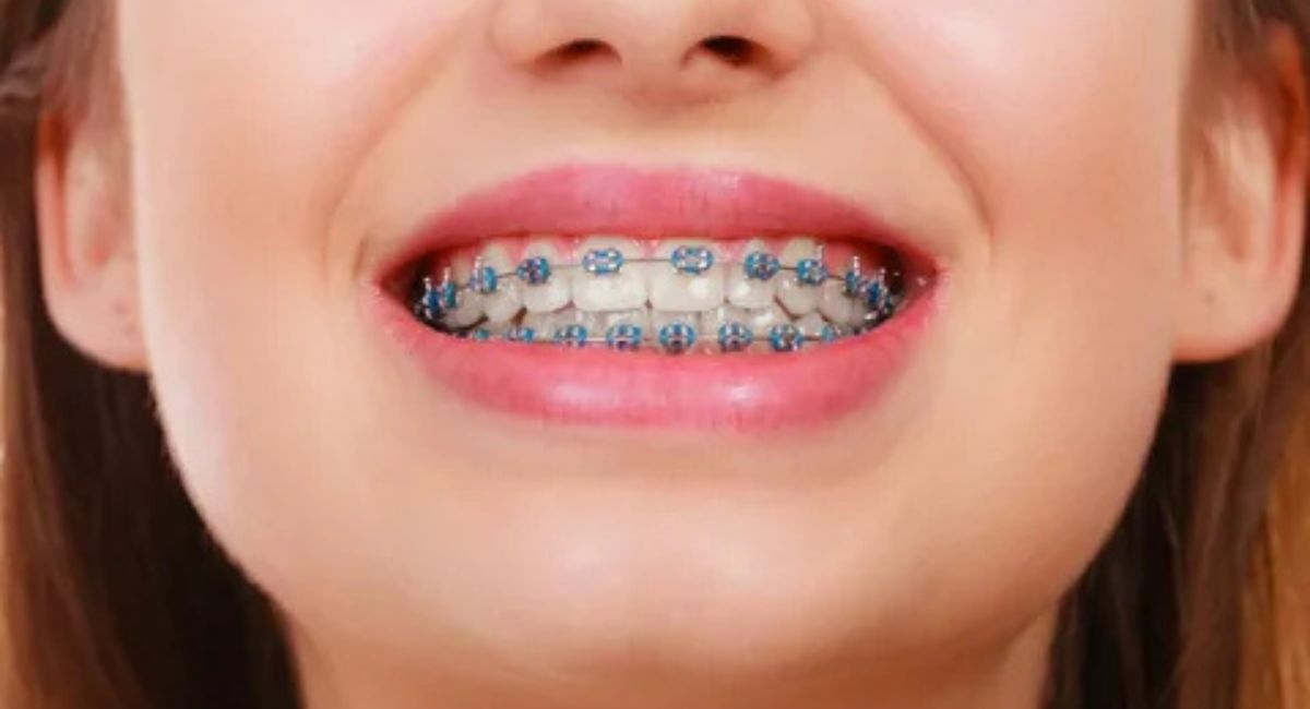 Jaw Before and After Braces: Complete Guide to Changes and Results 3 braces-for-jaw-problems