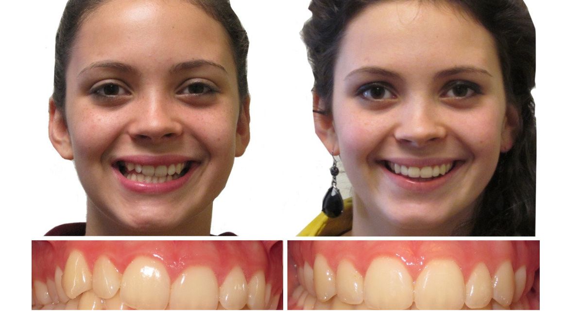 Jaw Before and After Braces: Complete Guide to Changes and Results 4 braces-vs-surgery