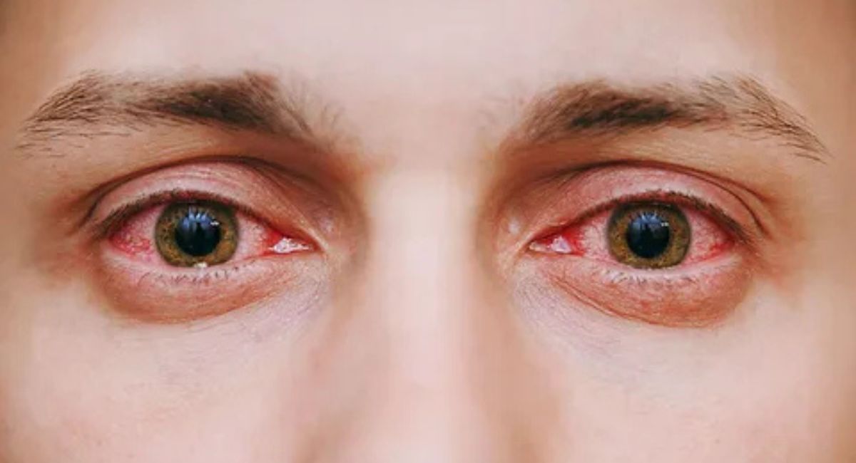 can you get pink eye from farting on a pillow