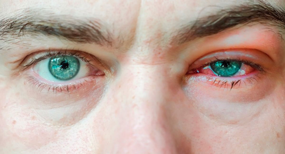 Can You Get Pink Eye from Farting on a Pillow? Myths, Facts, and Science 3 cause-pink-eye