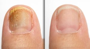Why Does My Nail Hurt After Getting Acrylics? 3 infection-or-inflammation