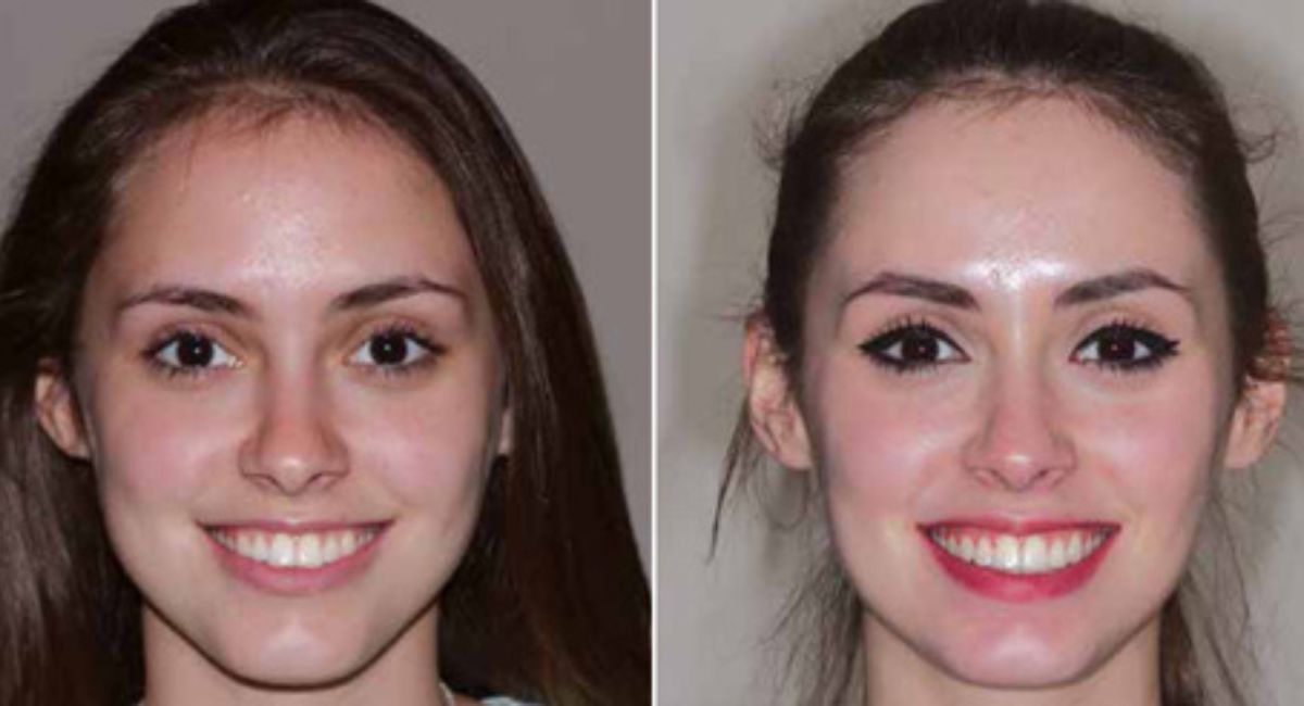 jaw-braces