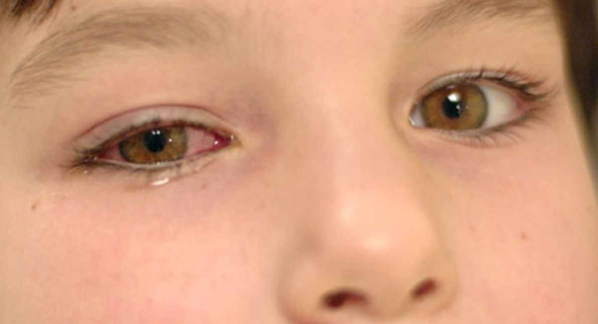 Can You Get Pink Eye from Farting on a Pillow? Myths, Facts, and Science 4 pink-eye