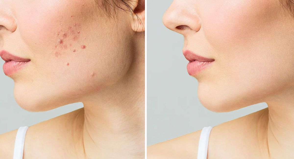 dermatologist-recommended-treatments-for-sun-spots