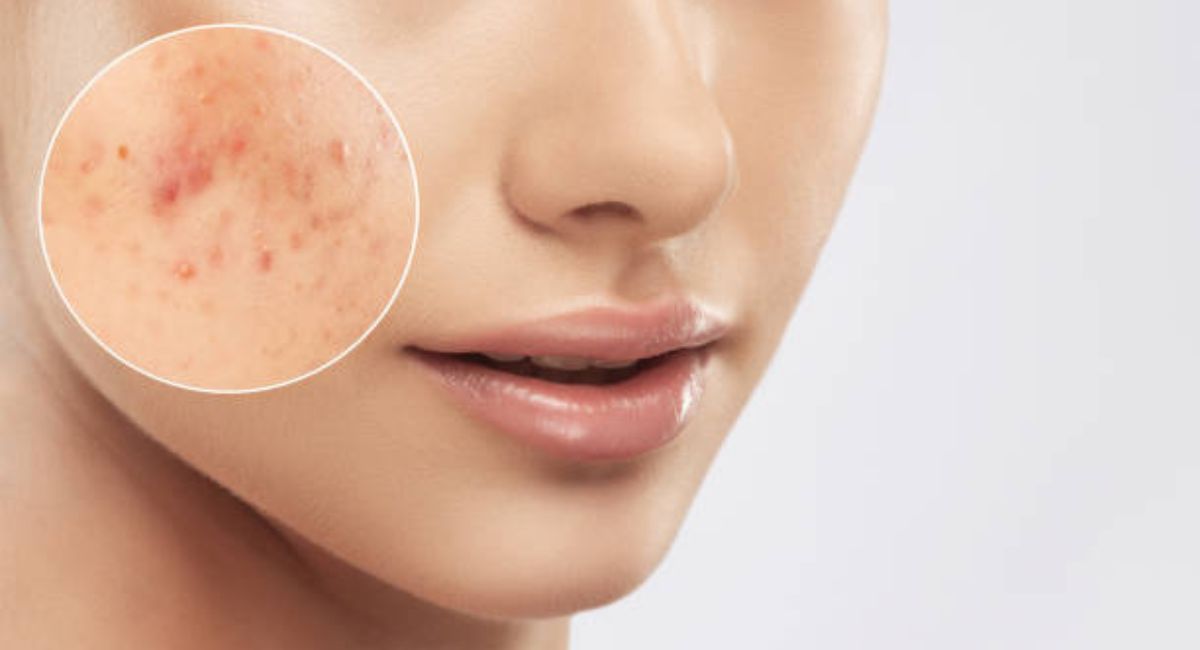 Best Exfoliator for Face Natural: Smooth, Radiant Skin Without Chemicals 3 common-skin-problems
