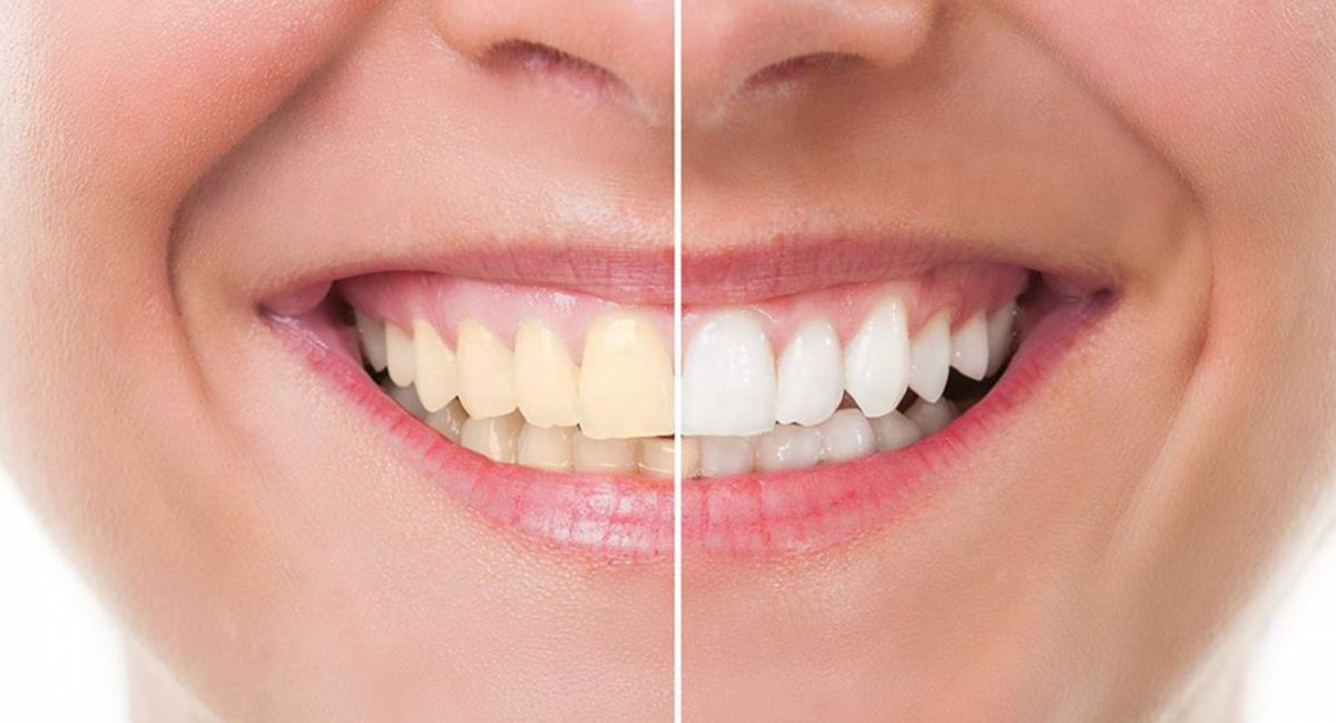 Can we Use Baking Soda to Brush Your Teeth? Shocking Truth 4 dental-care-tips-for-white-teeth