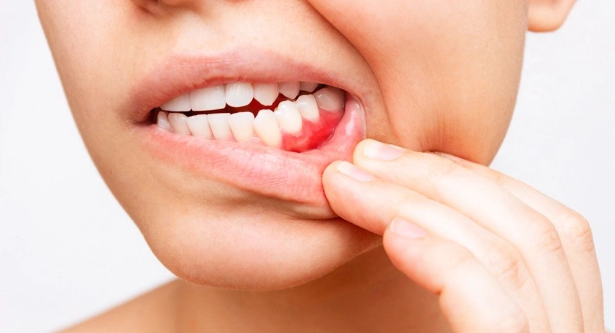 tooth-infection