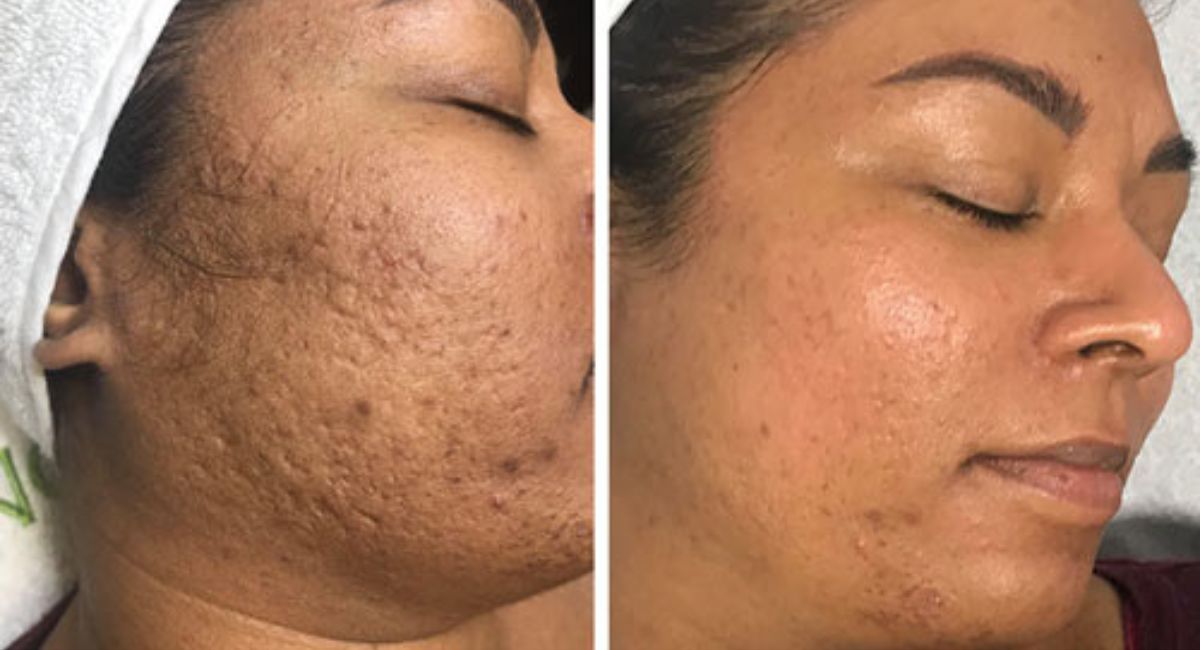 How Often Should You Dermaplane? Expert Tips for Smooth, Glowing Skin 4 age-impacts-how-often-you-should-dermaplane