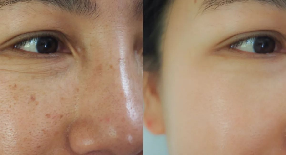 Black Spot Remover That Actually Works – Clear Skin Starts Here 2 black-spot-remover