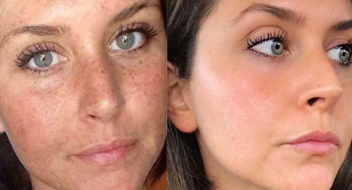 Black Spot Remover That Actually Works – Clear Skin Starts Here 1 black-spot