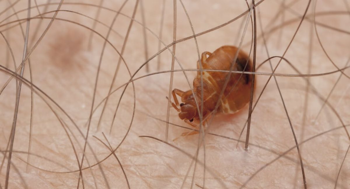 Can Bed Bugs Live in Your Hair? Experts Reveal the Truth You Need to Know 2 can-bed-bugs-live-in-your-hair