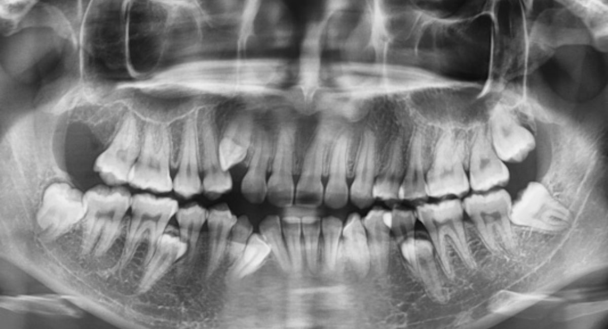 Can Wisdom Teeth Grow Back? The Truth Dentists Want You to Know 2 can-wisdom-teeth-grow-back