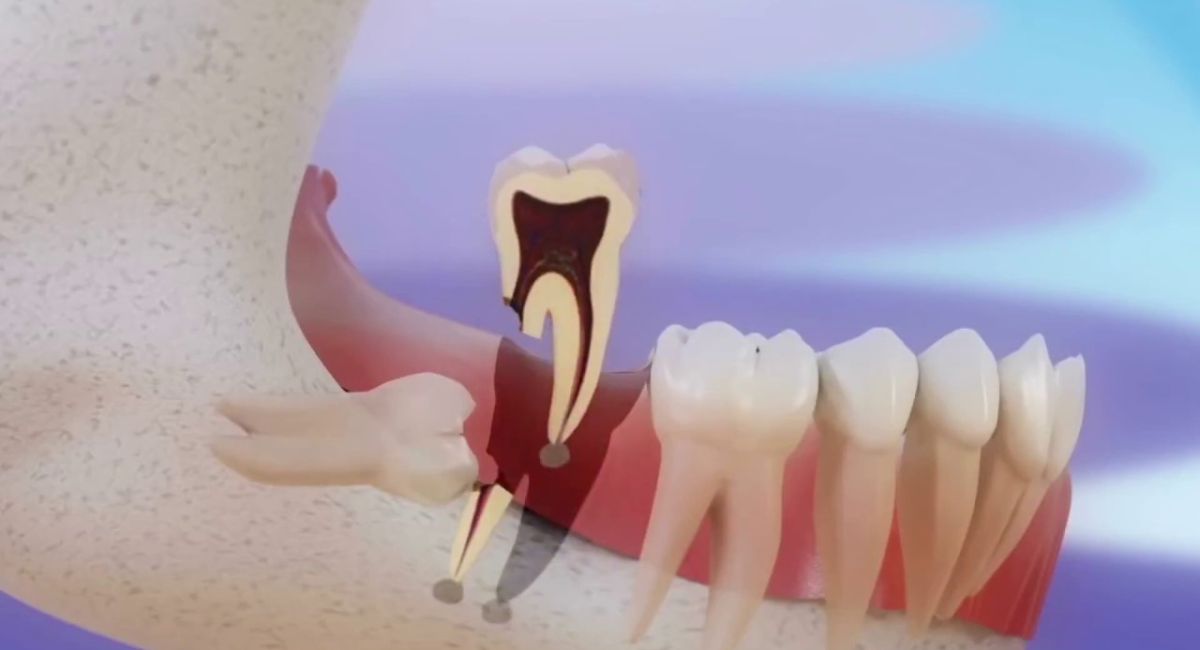 Can Wisdom Teeth Grow Back? The Truth Dentists Want You to Know 3 common-myths-about-wisdom-tooth