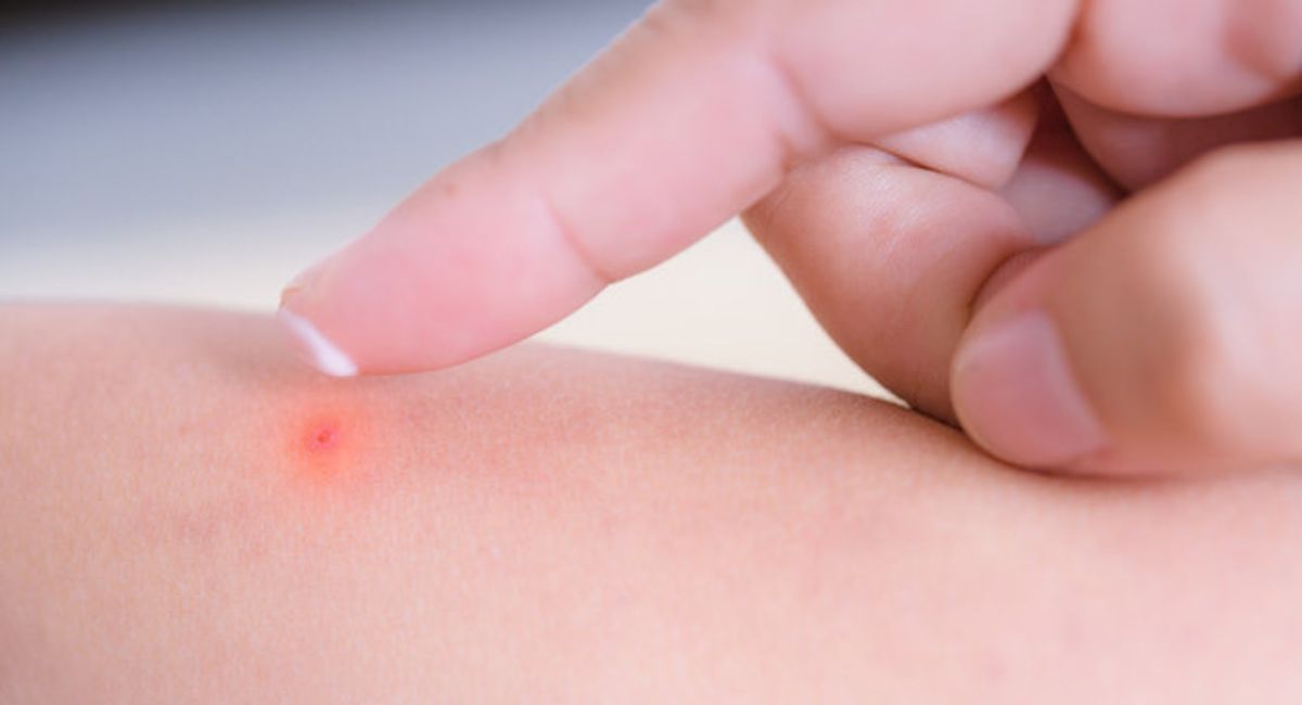 Natural Remedies for Bug Bites That Instantly Soothe Itching and Swelling 2 natural-remedies-for-bug-bites