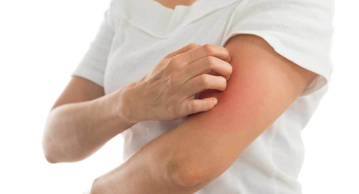 Natural Remedies for Bug Bites That Instantly Soothe Itching and Swelling 3 natural-ways-to-reduce-itching