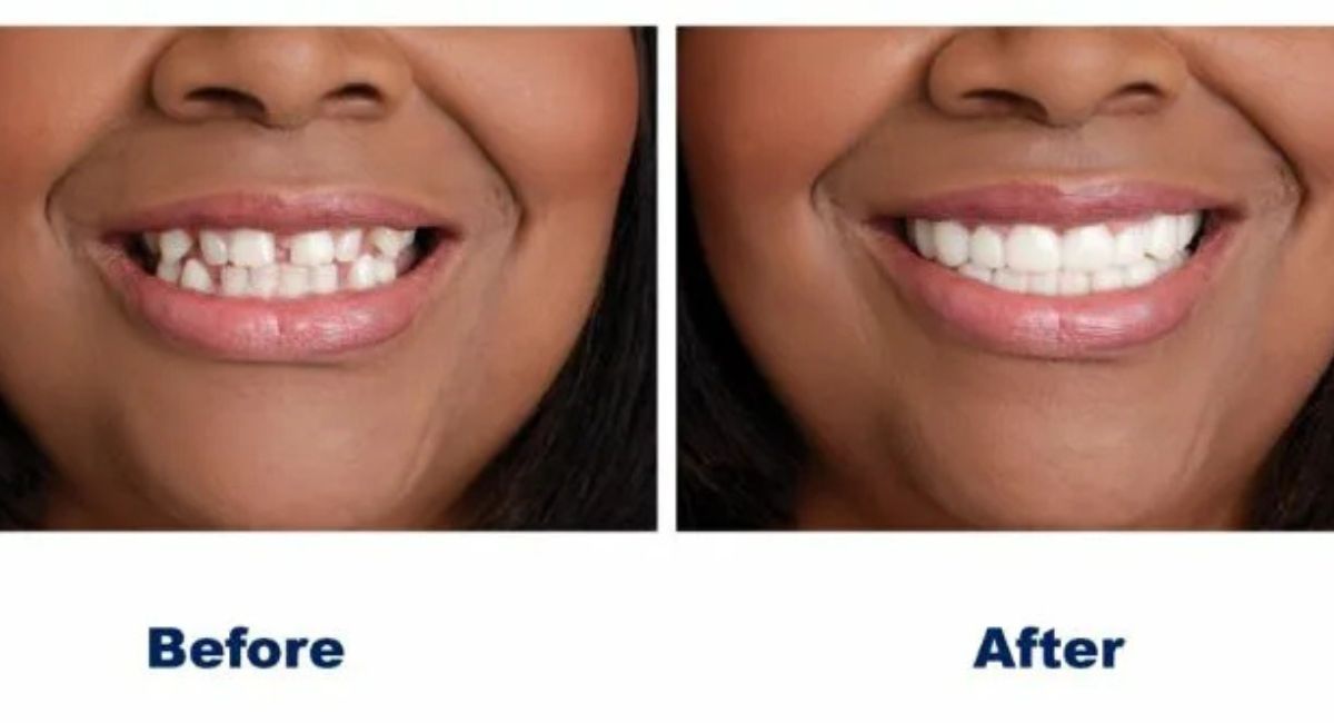 Can I Brush My Teeth After Wisdom Teeth Removal? What Dentists Recommend 4 real-recovery-experience